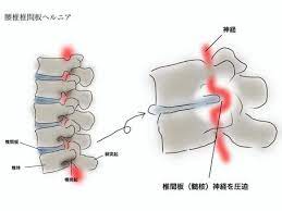 椎間板ヘルニアとは?